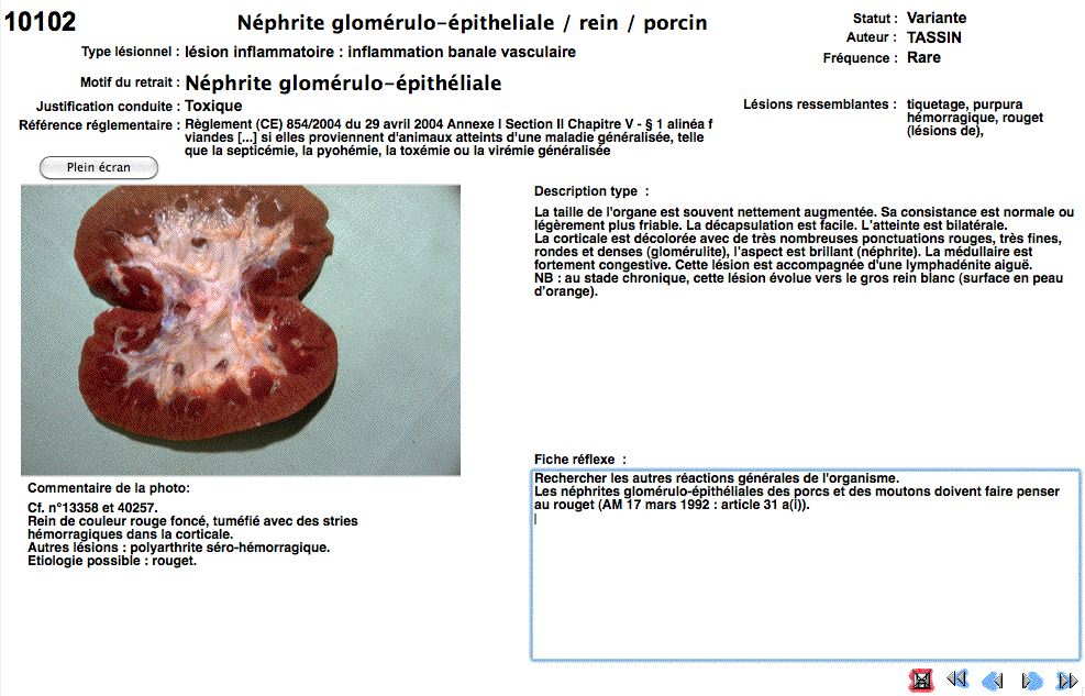 Photographie néphrite glomérulo-
								 épithéliale